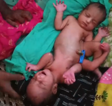 Do sir chaar haath aur do pair anokhe judwaan bacchi ko dekh