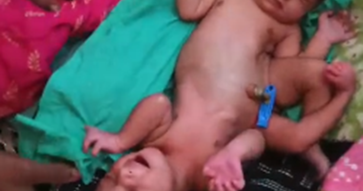 Do sir chaar haath aur do pair anokhe judwaan bacchi ko dekh